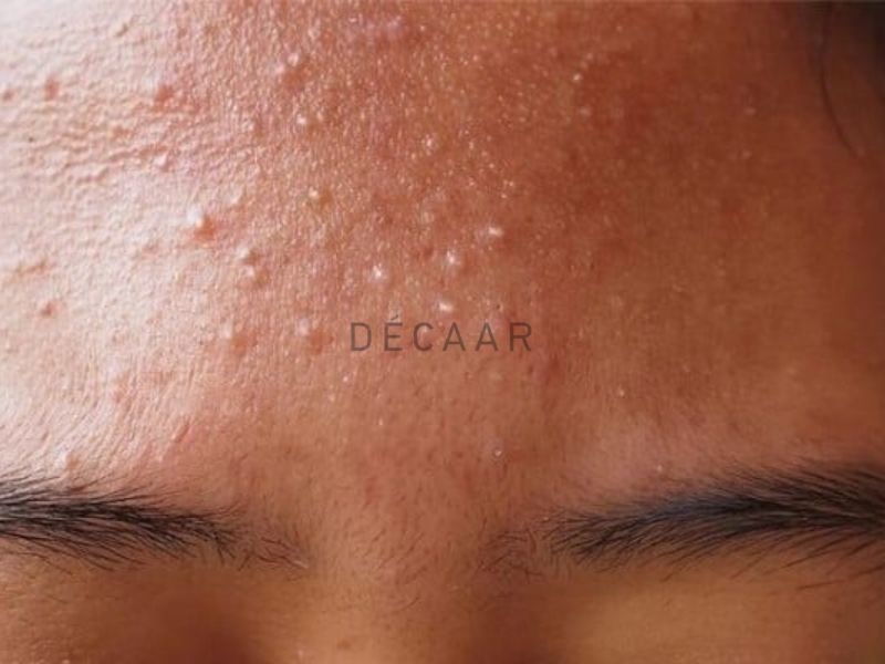 Một số loại thuốc có thể khiến hình thành mụn đầu trắng